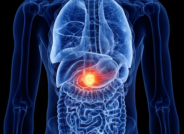 Rakovinu slinivky lze úspěšně operovat. Rozhodují dny, upozorňují lékaři