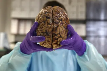 Čínská metoda slibuje chirurgické odstranění Alzheimera. Vědci řeší, jestli funguje